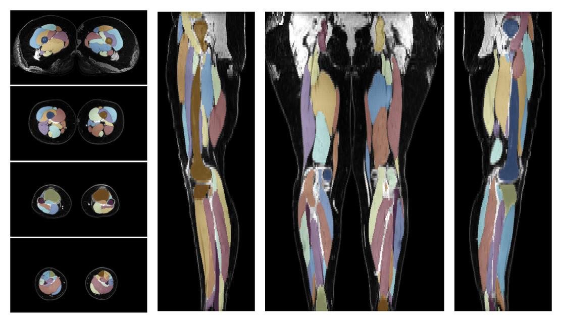 Overlay of automated muscle segmentation labels on dixon water image.